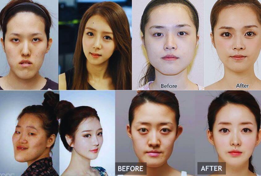 Before and After Korean Plastic Sugery